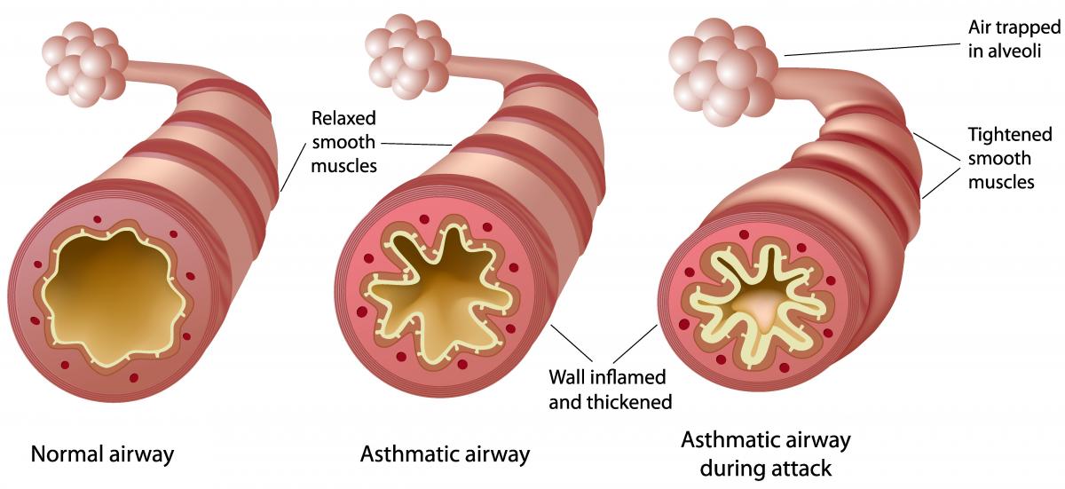 Airway