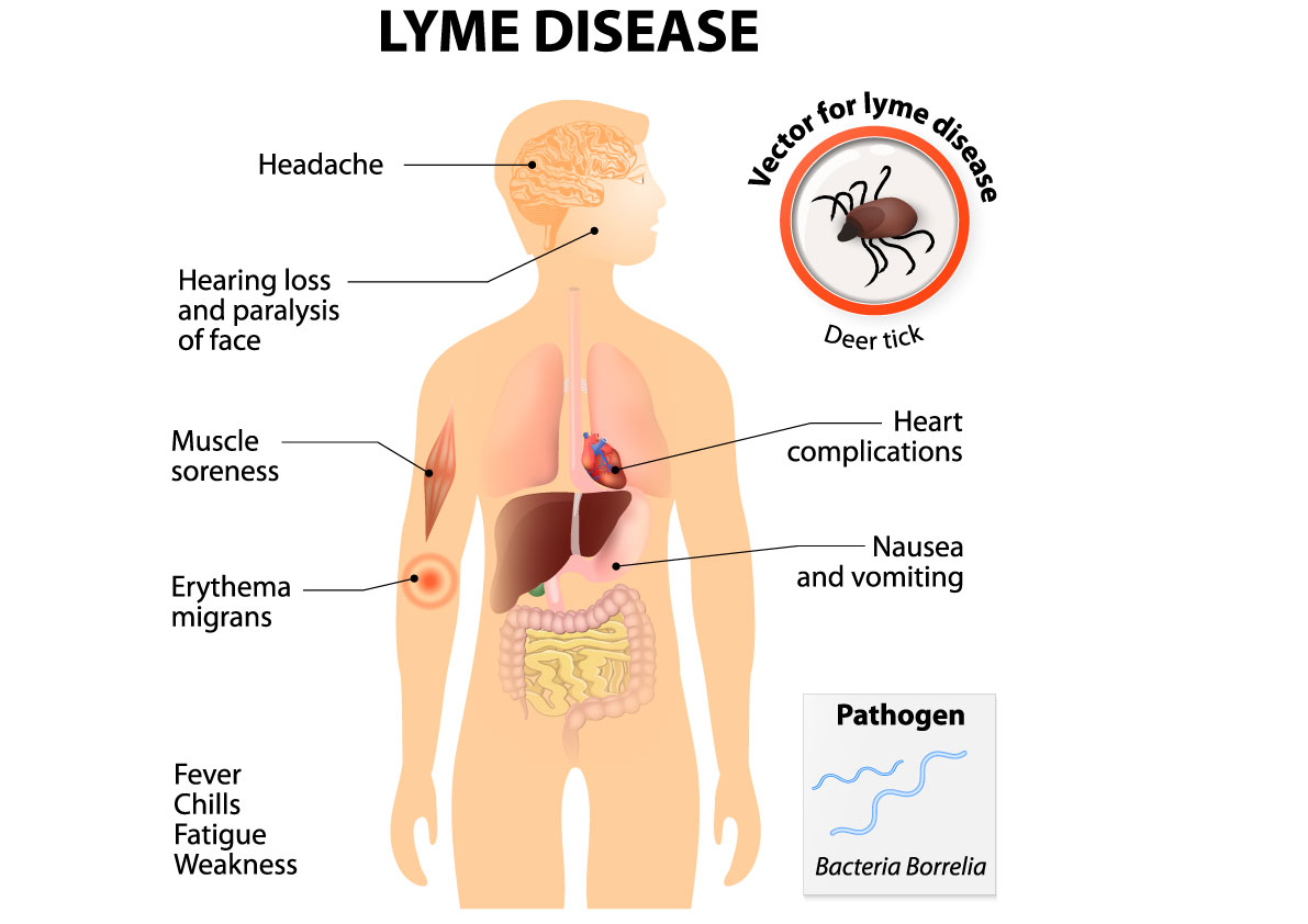 Disulfiram for Lyme Disease