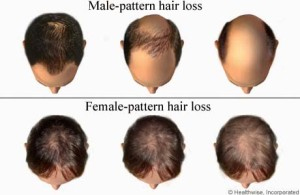 Hair Loss in Men and Women: Diagnosis and Treatment Options - CareFirst  Specialty Pharmacy's Blog