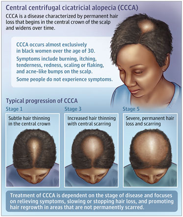 Topical Metformin for Alopecia - CareFirst Specialty Pharmacy's Blog