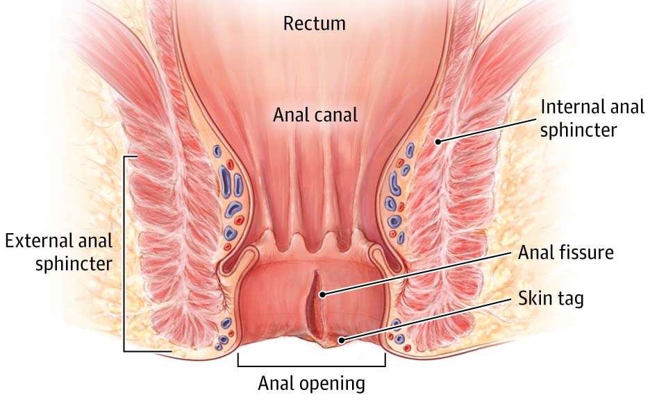 Anal Fissure Illustration by Kristen Wienandt Marzejon Medical Illustration & An